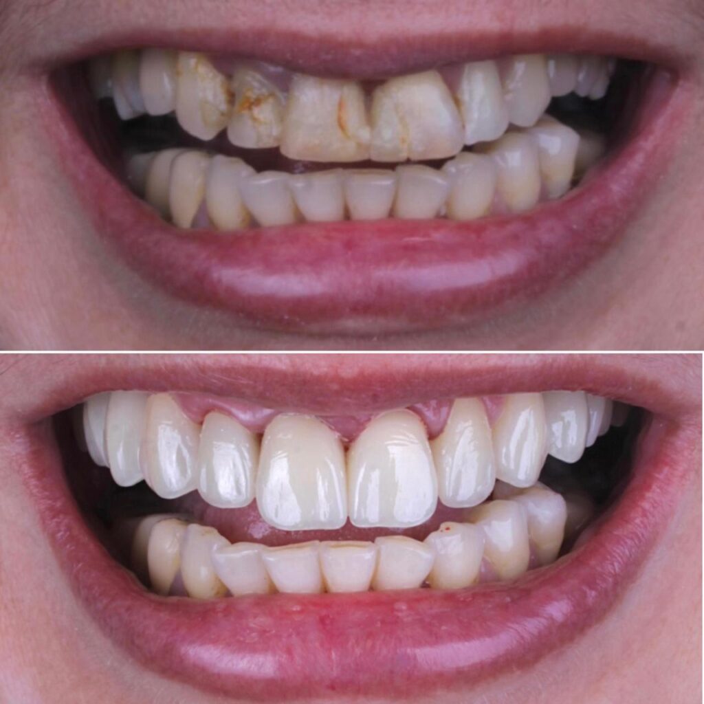 dente4