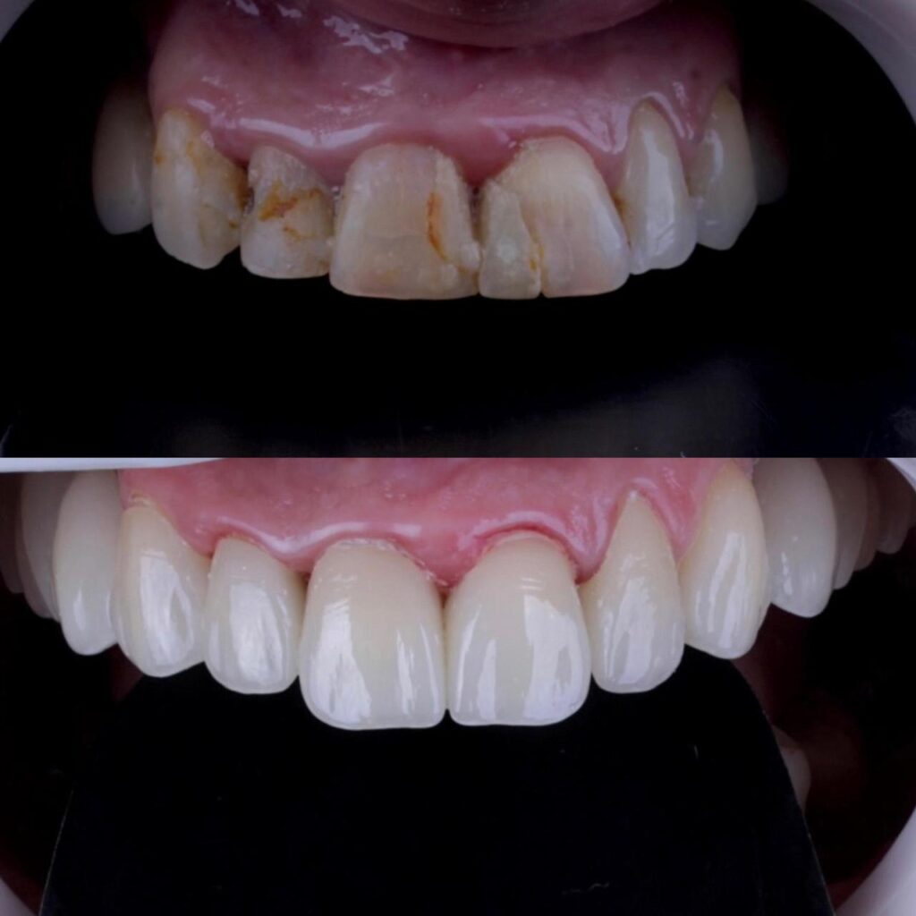 dente5