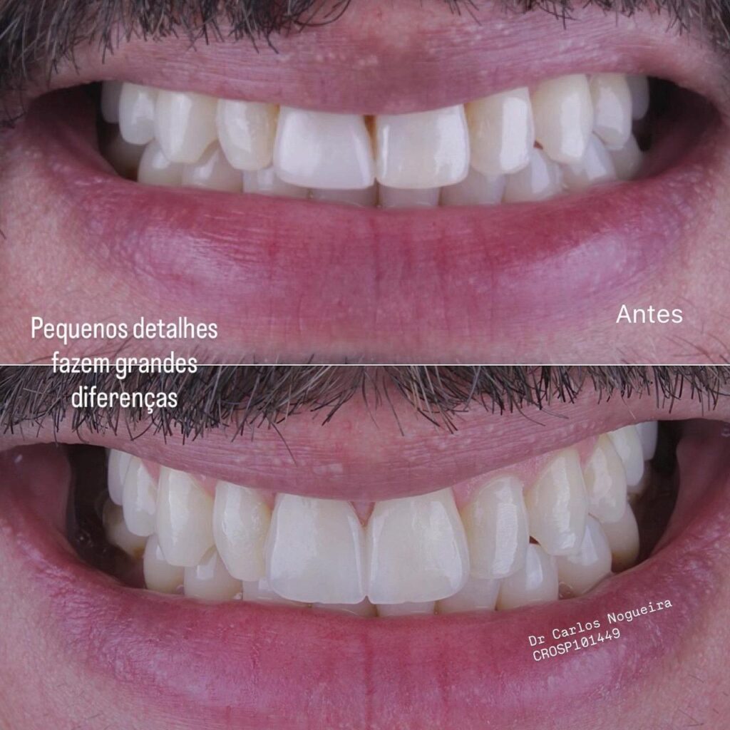 dente6