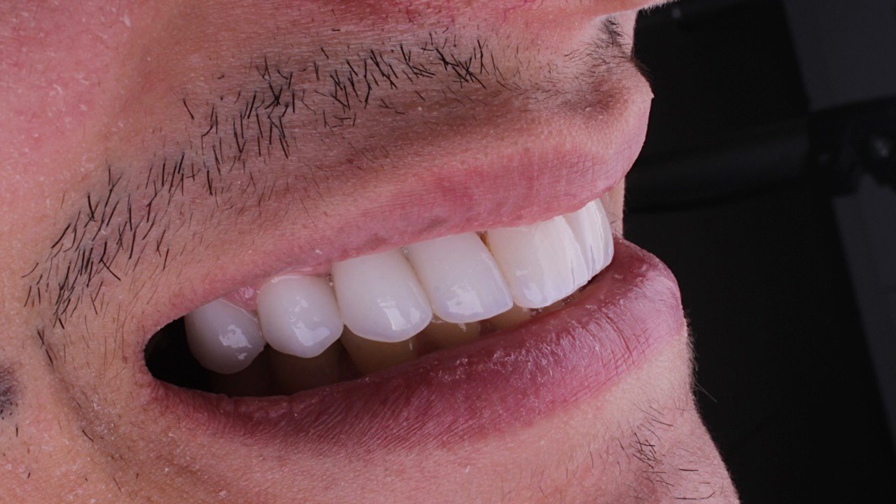 Vista lateral de um sorriso, com detalhes dos dentes anteriores