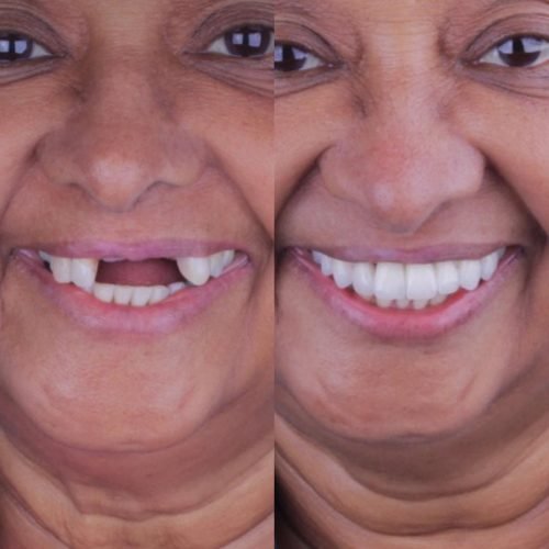 Before and after dental implants