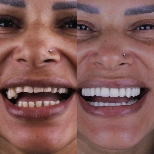 Implantes Dentários - Dr. Carlos Nogueira Arujá SP