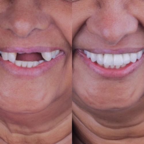 Antes e depois com lentes de contato dental realizadas pelo Dr. Carlos Nogueira em Arujá, São Paulo.