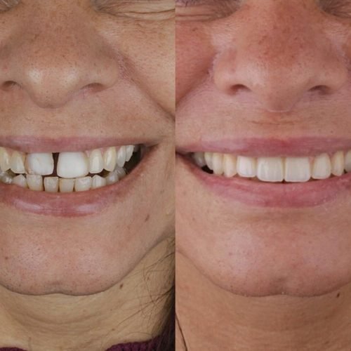 Antes e depois com lentes de contato dental realizadas pelo Dr. Carlos Nogueira em Arujá, São Paulo.
